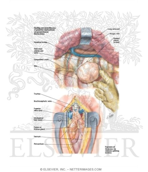 Watermarked preview of labeled image: Removal of Mediastinal Tumors