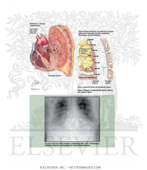 Watermarked preview of labeled image: Heart Disease In Pleural Effusion