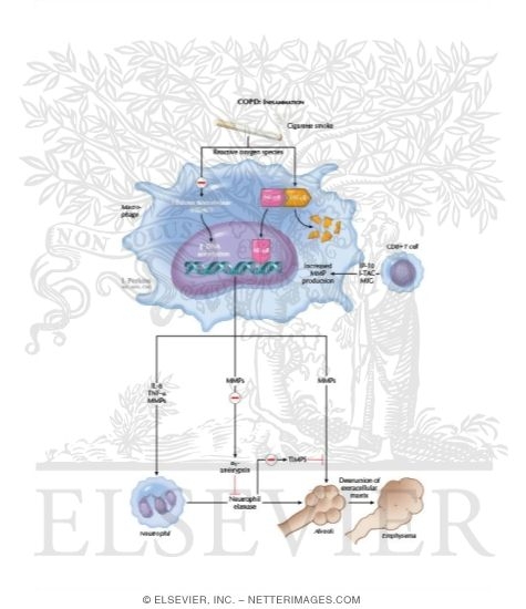 Watermarked preview of labeled image: COPD: Inflammation