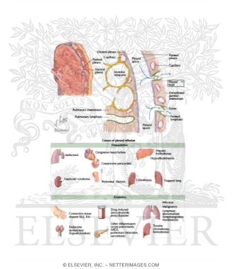 Watermarked preview of labeled image: Pathophysiology of Pleural Fluid Accumulation