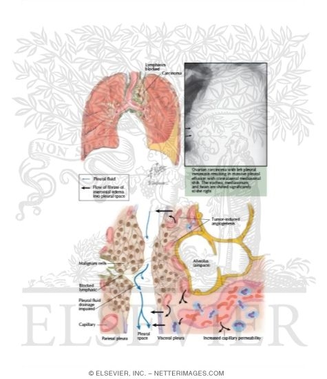 in pleural effusion parapneumonic effusion