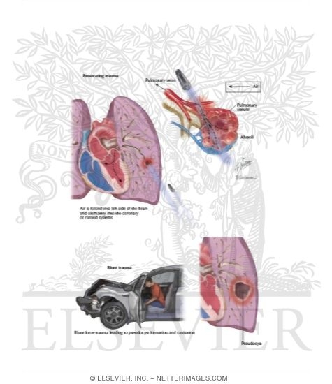 Pulmonary Laceration