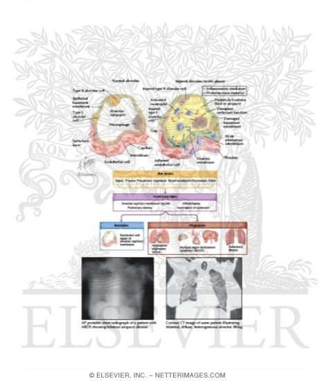 Watermarked preview of labeled image: Acute Lung Injury