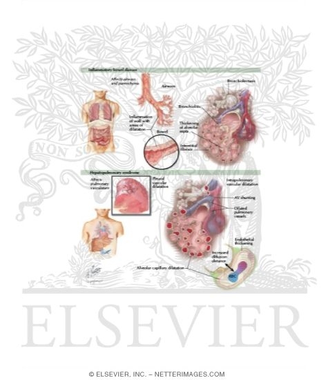 Watermarked preview of labeled image: Pulmonary Manifestations of Inflammatory Bowel Disease (IBD) and Liver Disease