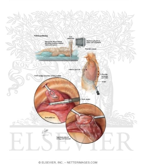 Watermarked preview of labeled image: Video Assisted Thoracoscopic Surgery (VATS)