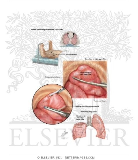 Lung Volume Reduction Surgery (LVRS)