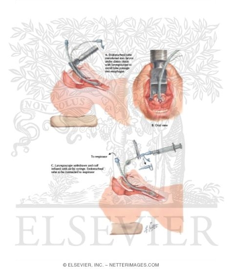 Watermarked preview of labeled image: Endotracheal Intubation