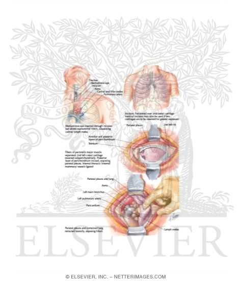 Mediastinotomy and Mediastinoscopy