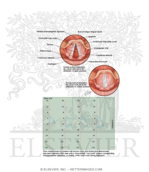 Watermarked preview of labeled image: Vocal Cord Dysfunction