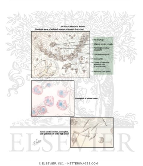 Watermarked preview of labeled image: Bronchial Asthma
