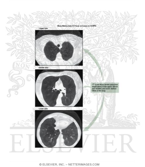 Watermarked preview of labeled image: Chronic Obstructive Pulmonary Disease