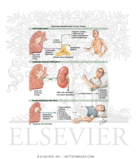 Watermarked preview of labeled image: Paraneoplastic Manifestations of Lung Cancer