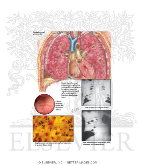Staphylococcus Aureus Pneumonia