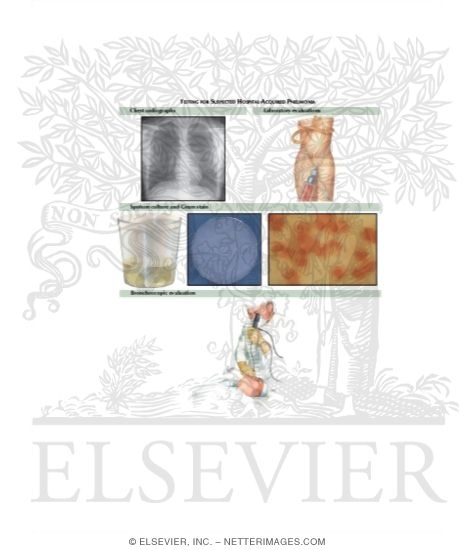 Watermarked preview of labeled image: Testing for Suspected Hospital-Acquired Pneumonia