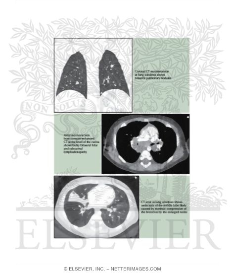 Watermarked preview of labeled image: Histoplasmosis
