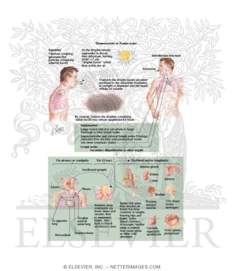 Tuberculosis