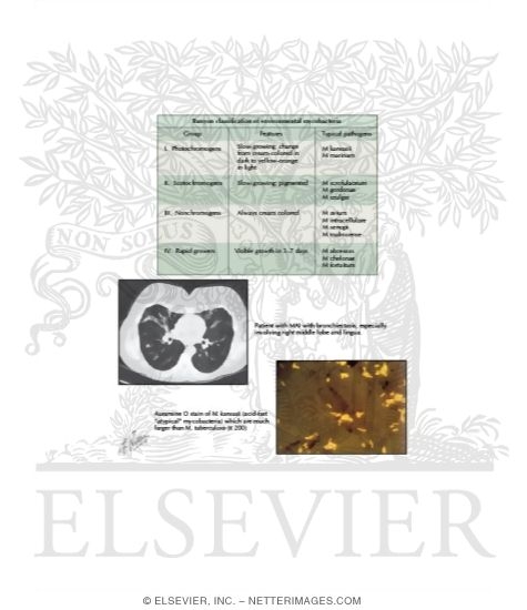 Watermarked preview of labeled image: Nontuberculous Mycobacterial Lung Disease