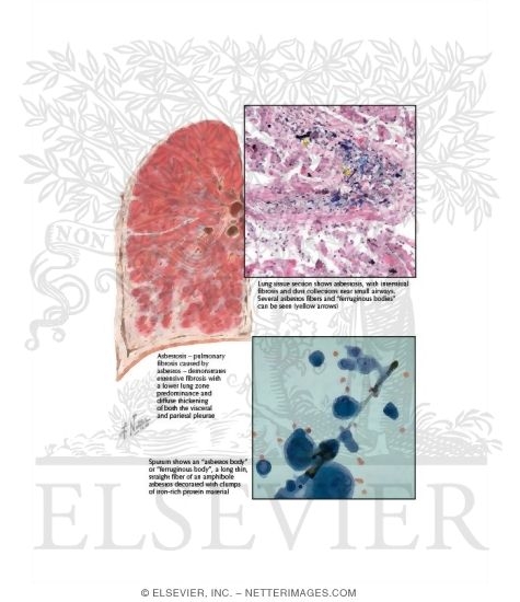 Asbestosis