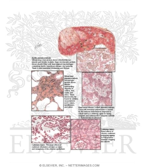 Pneumoconiosis Caused By Various Minerals and Mixed Dusts