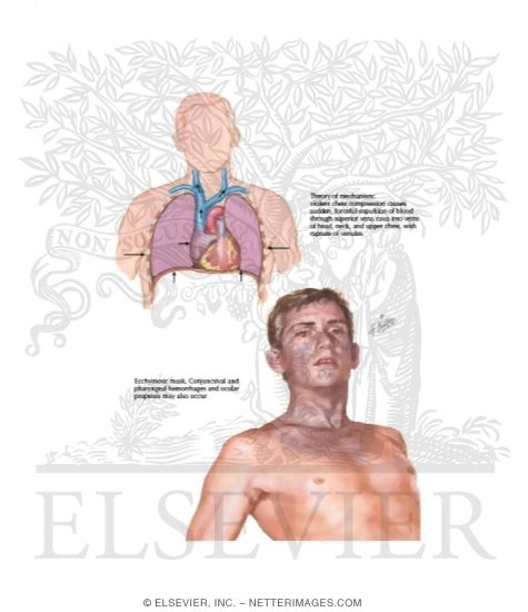 Traumatic Asphyxia