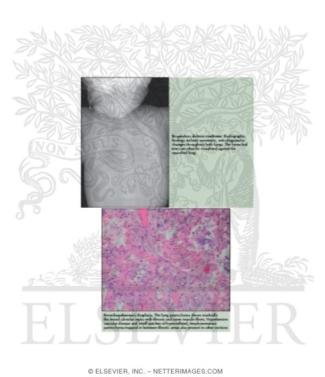 Watermarked preview of labeled image: Respiratory Distress Syndrome