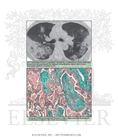 Watermarked preview of labeled image: Cryptogenic Organizing Pneumonia