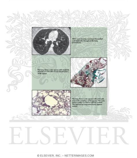 Watermarked preview of labeled image: Lymphangioleiomyomatosis