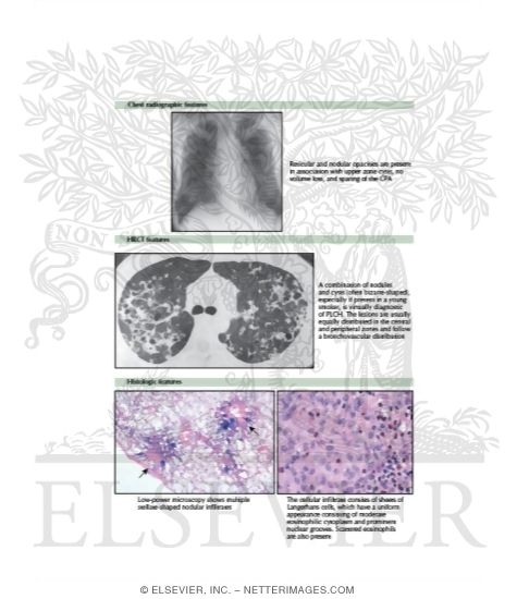 Watermarked preview of labeled image: Pulmonary Langerhans Cell Histiocytosis