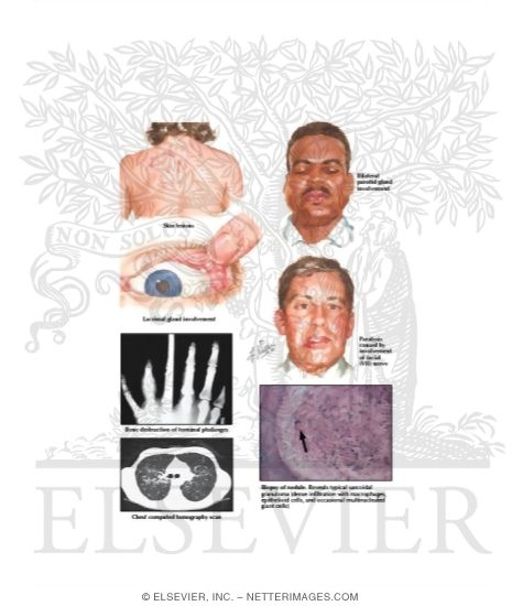 Watermarked preview of labeled image: Sarcoidosis