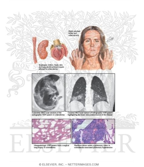 Watermarked preview of labeled image: Systemic Sclerosis (Scleroderma)