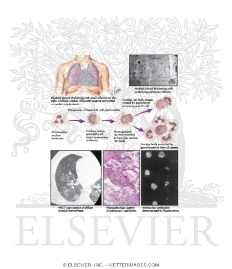 Watermarked preview of labeled image: Systemic Lupus Erythematosus