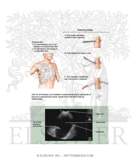 Watermarked preview of labeled image: Introduction of Chest Drainage Tubes
