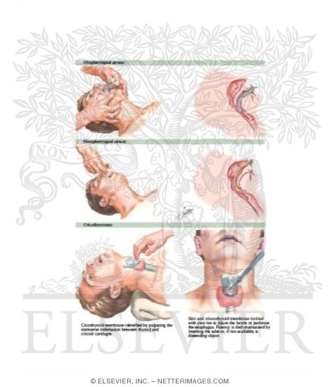 Watermarked preview of labeled image: Securing an Emergent Airway