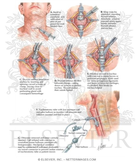 Watermarked preview of labeled image: Tracheostomy