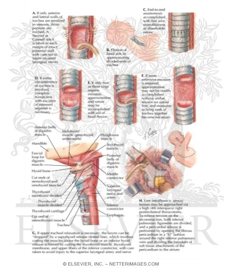 tracheal resection and anastomosis anastomosis