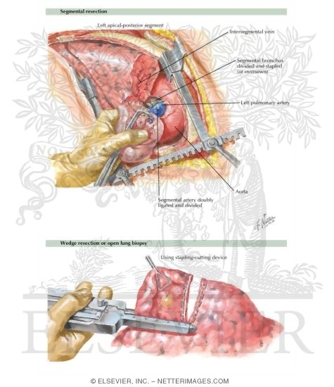 Watermarked preview of labeled image: Sublobar Resection and Surgical Lung Biopsy