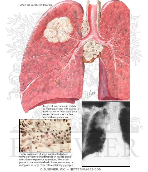 Watermarked preview of labeled image: Bronchogenic Carcinoma; Large Cell Anaplastic Type