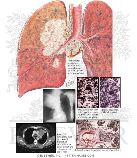 Bronchogenic Carcinoma: Small Cell Anaplastic (Oat Cell) Type