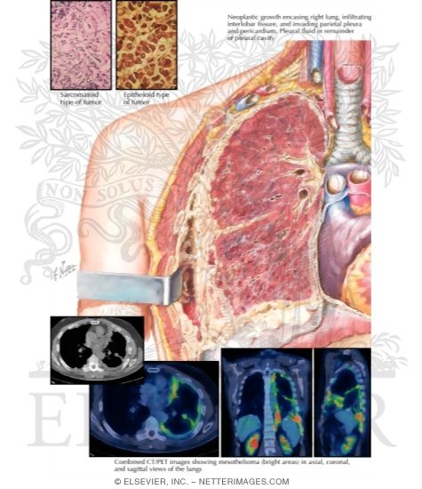 Mesothelioma of Pleura