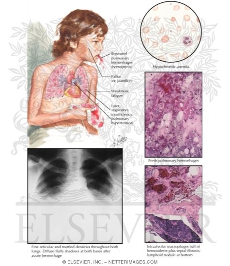 Idiopathic Pulmonary Hemosiderosis