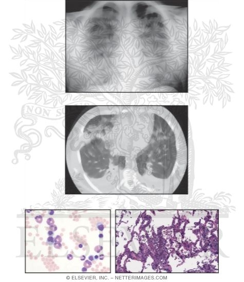 Watermarked preview of unlabeled image: Eosinophilic Pneumonia