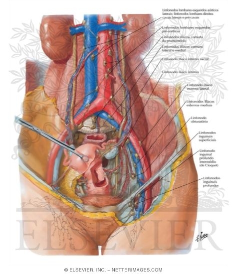 Lymph Vessels and Nodes of Pelvis and Genitalia: Female
Lymphatic Drainage II - Internal Genitalia