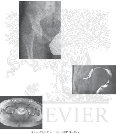 Watermarked preview of unlabeled image: Hip Radiograph, Arthrogram, MR and PETCT Fusion
