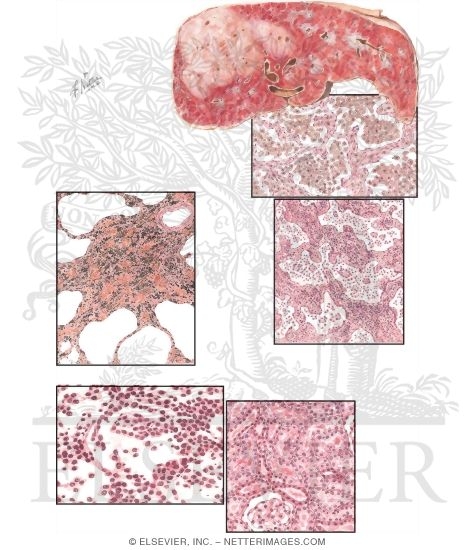 Pneumoconiosis Caused By Various Minerals and Mixed Dusts