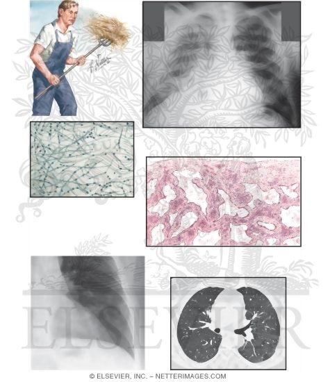 Hypersensitivity Pneumonitis