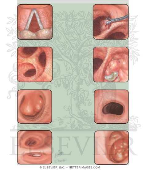 Bronchoscopic Views
