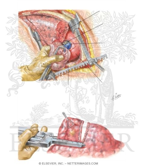 Sublobar Resection and Surgical Lung Biopsy