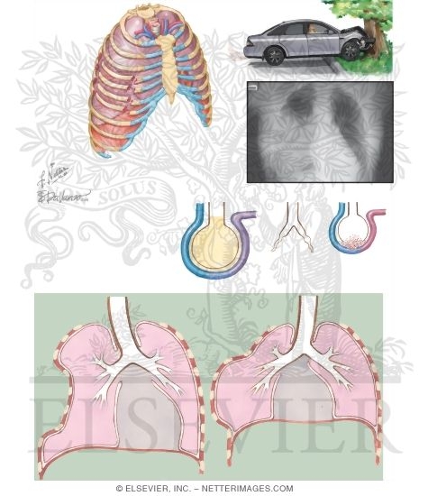 Flail Chest and Pulmonary Contusion