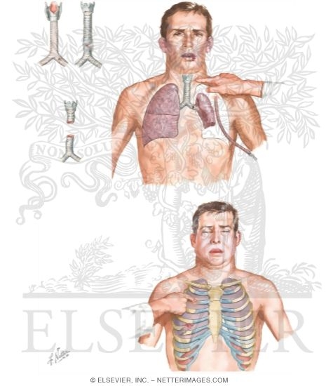 Tracheobronchial Rupture
