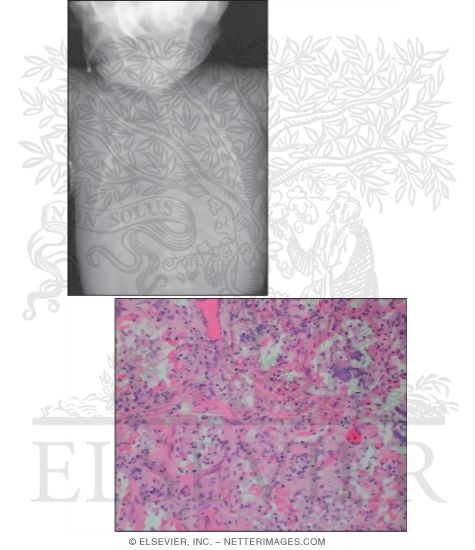 Watermarked preview of unlabeled image: Respiratory Distress Syndrome